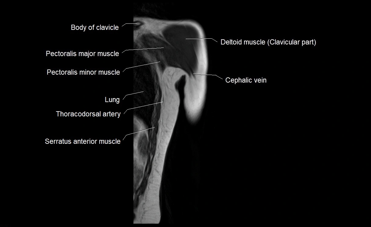MRI upper arm (humerus ) coronal cross sectional anatomy image 2.webp